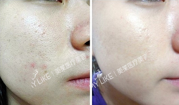 收縮毛孔.jpg