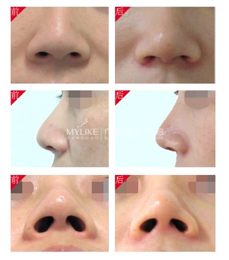 鼻翼縮小.jpg