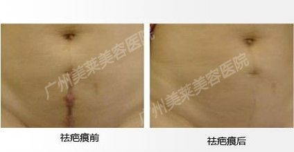 祛除產(chǎn)后疤痕 我更加自信