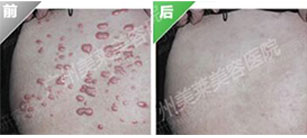 疤痕疙瘩的預防