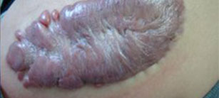 疤痕醫(yī)生全根解讀祛疤小常識