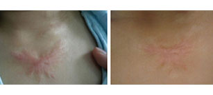 關于疤痕疙瘩，你懂的有多少