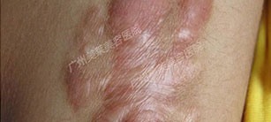 瘢痕疙瘩應該如何護理