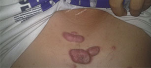 疤痕疙瘩的三大類型