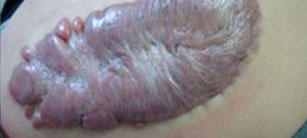 夏季炎熱疤痕容易惡變?cè)趺崔k