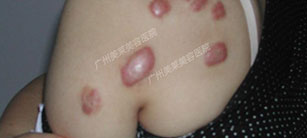 疤痕疙瘩的顯著特點(diǎn)及治療