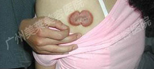 疤痕疙瘩會(huì)不會(huì)遺傳給子女