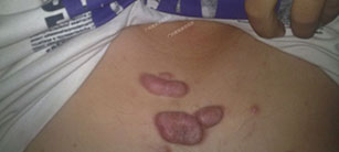 外傷疤痕疙瘩治療案例