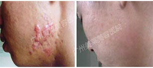 疤痕疙瘩痛癢難忍，關(guān)鍵選好祛疤方法