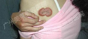 疤痕疙瘩危害大，美萊隱形祛疤修復(fù)術(shù)治療效果好