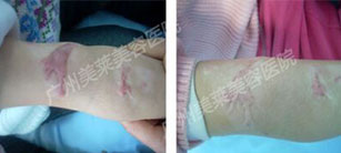 疤痕疙瘩為什么難治愈