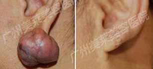 疤痕疙瘩的中醫(yī)治療