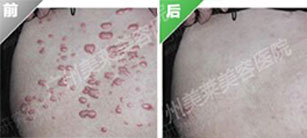 疤痕疙瘩如何治療，怎么去除瘢痕疙瘩