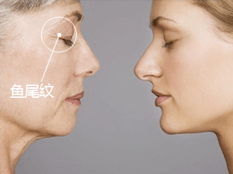 祛魚尾紋