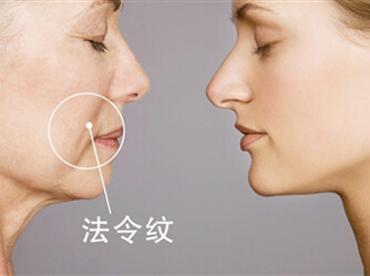 祛法令紋