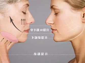 中醫(yī)埋線提升