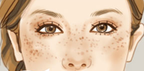 激光祛黃褐斑后還會再反彈嗎