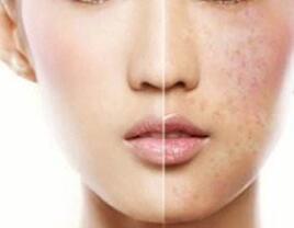 激光祛黃褐斑后還會再反彈嗎