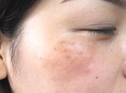 黃褐斑出現(xiàn)原因以及治療方法