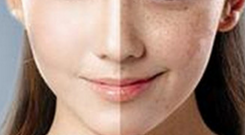 激光祛斑術(shù)后護(hù)理需要注意什么事項(xiàng)