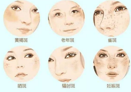 激光祛斑術(shù)后護(hù)理需要注意什么事項(xiàng)