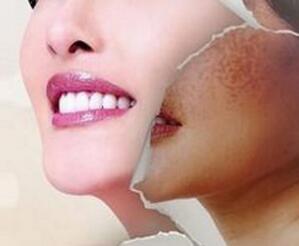 激光祛斑的恢復(fù)期有多長