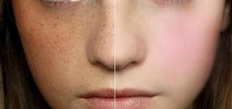 激光美容祛斑多少錢