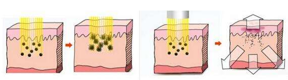 臉部做激光祛斑多少錢(qián)