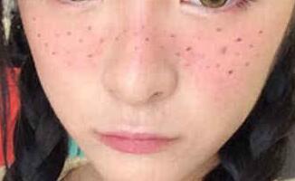 皮秒祛斑后多久恢復(fù)自然