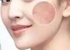 激光祛斑后會不會反彈