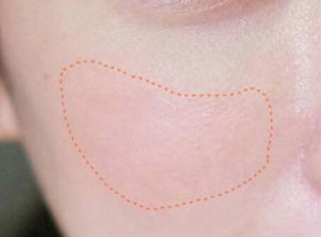 皮秒祛斑恢復(fù)時間長嗎