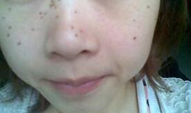 皮秒祛斑會有結痂嗎