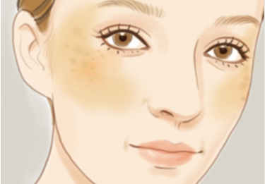 激光祛斑會不會留疤