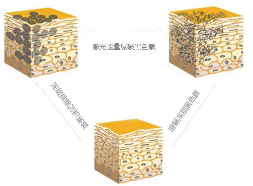 做激光祛斑會不會有風險