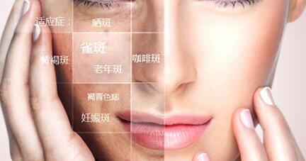 激光祛斑的結痂要多久脫落