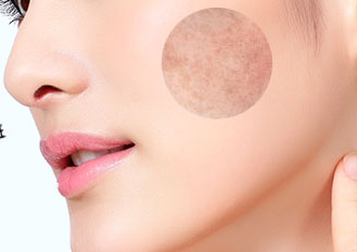 激光祛斑價(jià)格一般是多少