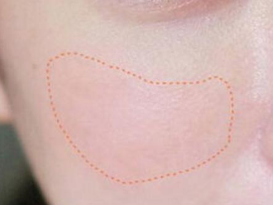 激光祛斑后注意事項有哪些