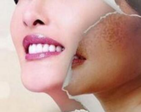 激光祛斑的恢復(fù)期要多久