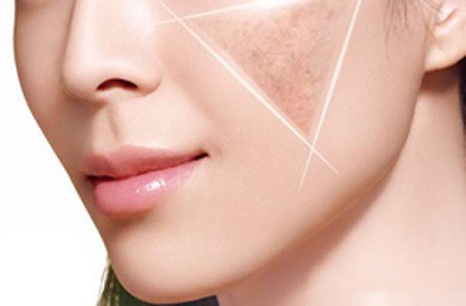 做完激光祛雀斑之后能洗臉嗎