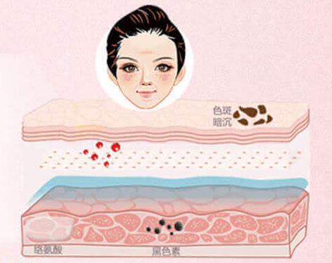 激光祛雀斑后還會(huì)反彈嗎