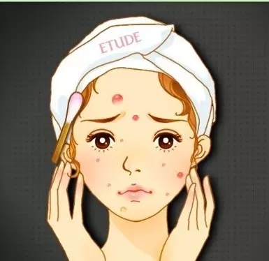 做了激光祛痘后還會反彈嗎