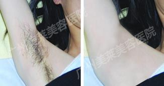 激光脫腋毛要多久才能恢復(fù)呢