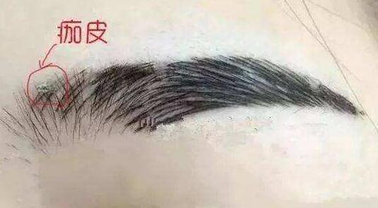 紋眉后需要注意的事項(xiàng)