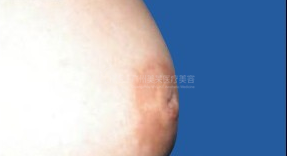 乳頭凹陷1.png