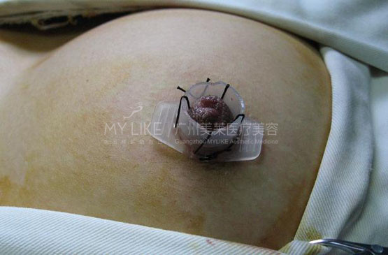 乳頭凹陷2.jpg