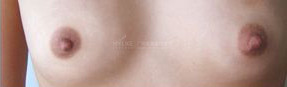 乳頭過大+乳暈過大-術(shù)后.jpg