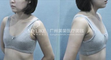 直播我的隆胸經(jīng)歷1 (2).jpg