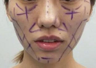 脂肪填充面部常見(jiàn)的后遺癥