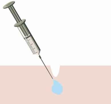 長期打玻尿酸的危害有哪些