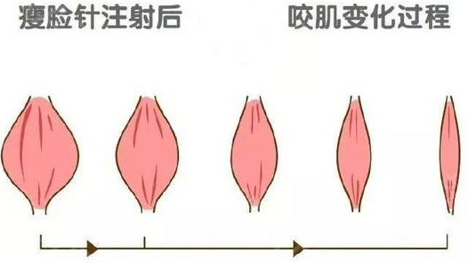 瘦臉針效果明顯嗎